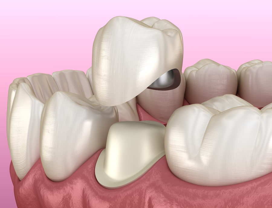 dental crowns