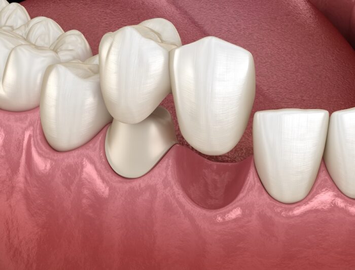 Cantilever bridge made from ceramic, frontal tooth recovery. Medically accurate 3D animation of dental concept