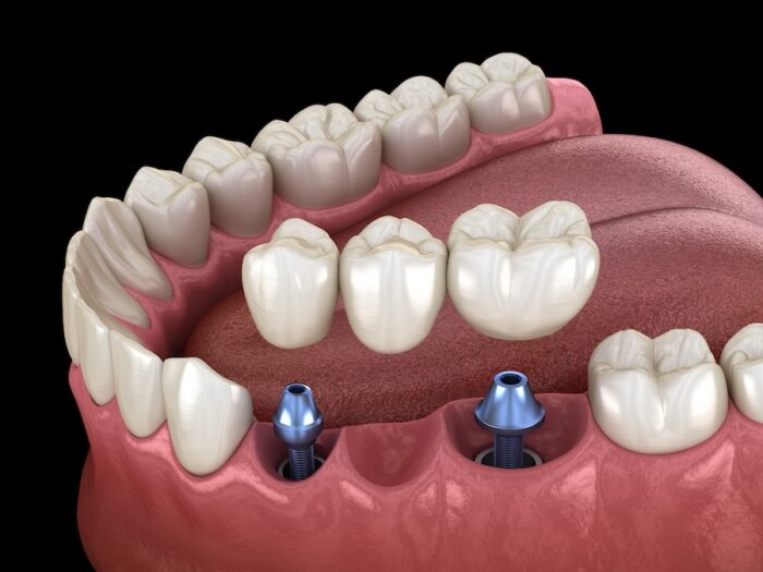 Dental bridge supported by implants. Medically accurate 3D illustration of human teeth and dentures concept
