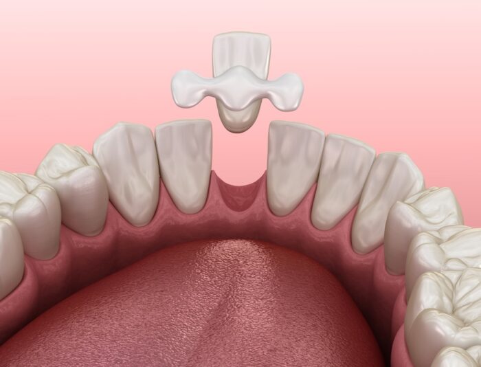 Maryland bridge made from ceramic, front tooth recovery. Medically accurate 3D illustration of dental concept